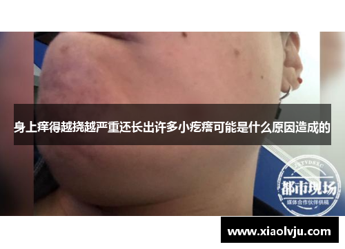 身上痒得越挠越严重还长出许多小疙瘩可能是什么原因造成的